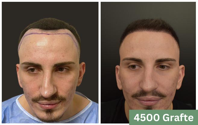 Tranplanti i flokut alex