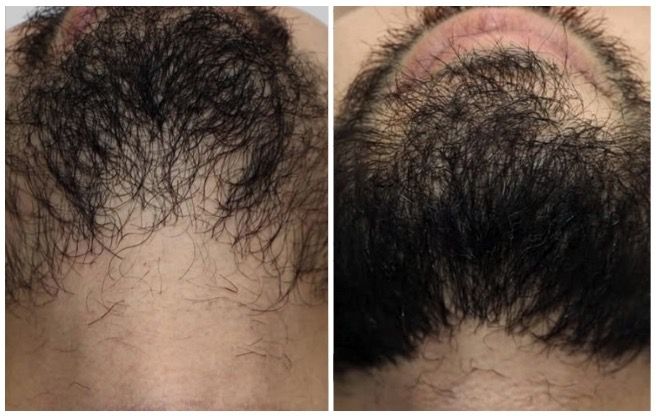 transplanti i mjekres