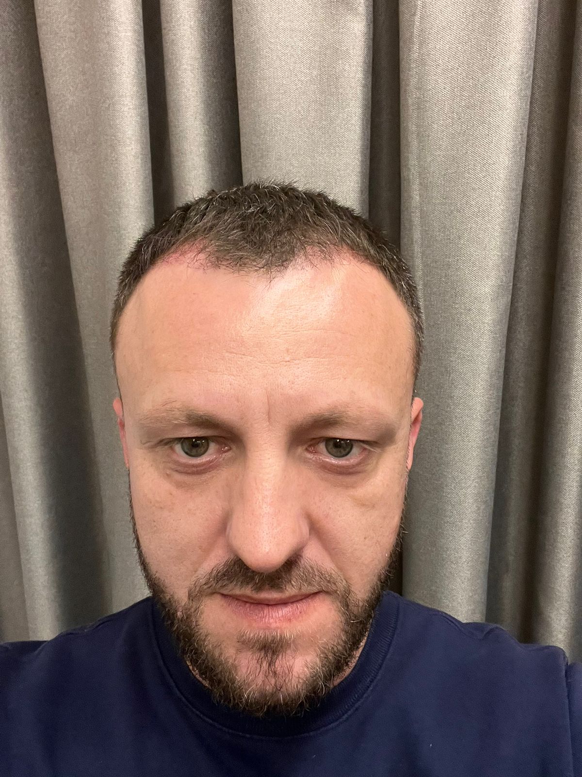 3 muajt e parë pas transplantit të flokëve